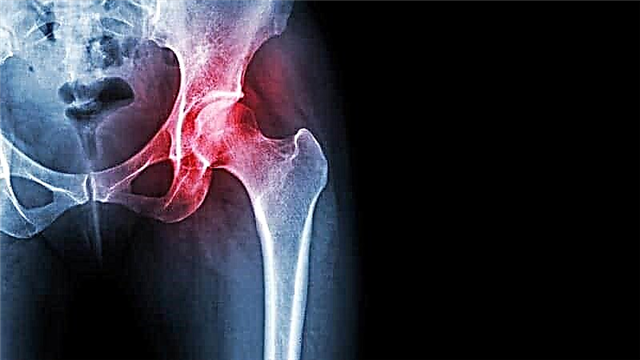 Zlomenina stehenní kosti: typy, příznaky, taktika léčby