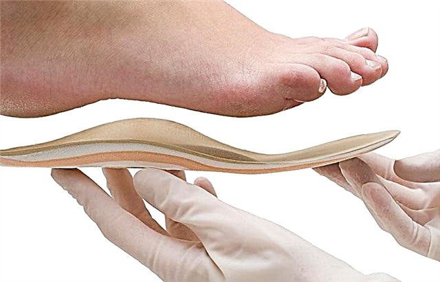 Orthopedic insoles for hallux valgus. Review, reviews, recommendations