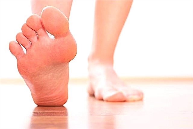 Treatment of flat feet in adults at home